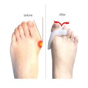 Bunion Supporter With Overlapping Toe