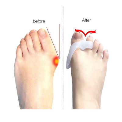 Bunion Supporter With Overlapping Toe