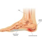 How-To-Reduce-Foot-Pain-From-Plantar-Fasciitis